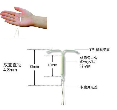 元宫型CU365节育环安装过程视频，一位妇科医生的真实手记