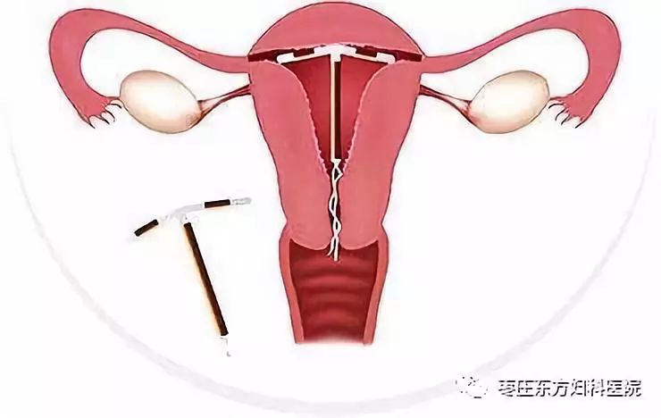 元宫型Cu365节育环放取视频，一位妇产科医生的手记