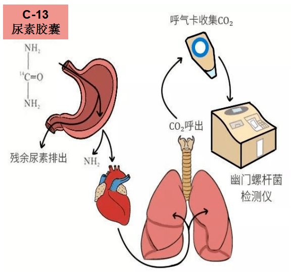 元宫型CU365节育环上环视频，一个医生妈妈的真实分享
