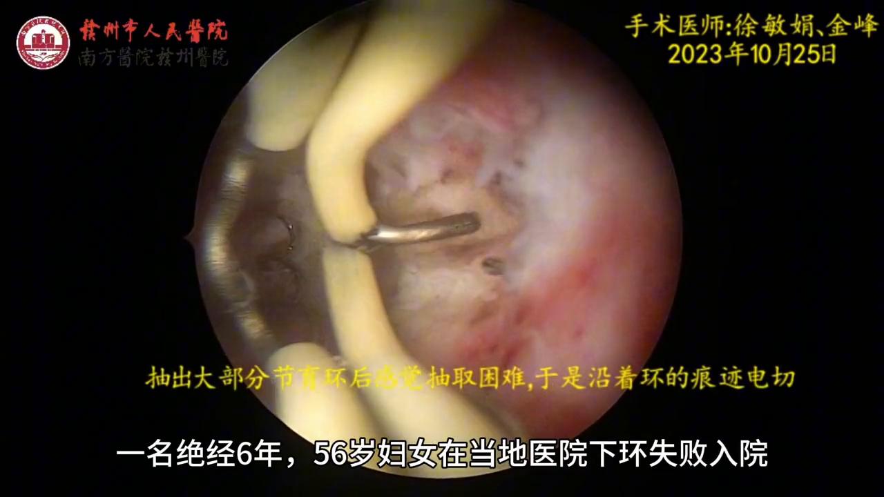 元宫型CU365节育环上环视频，到底该不该看？