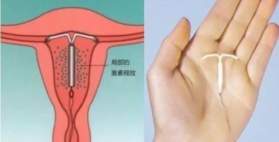 元宫cu365节育环上环视频，一个普通女性的真实经历分享