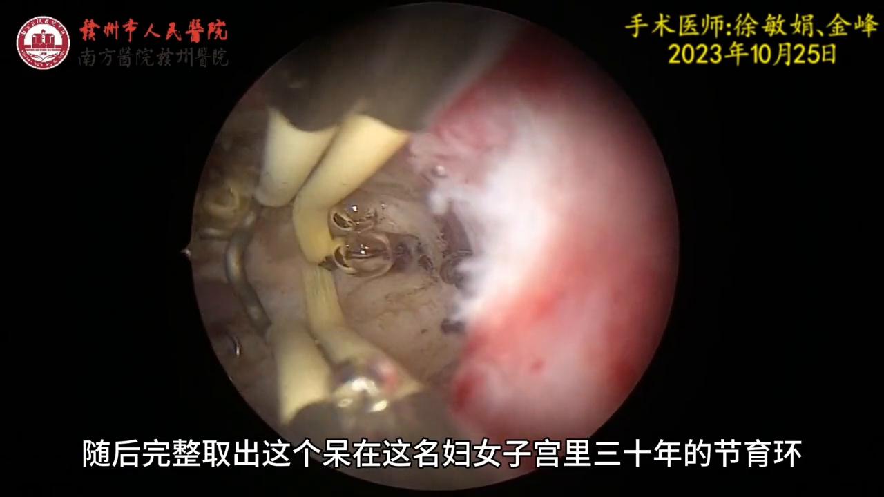 元宫cu365节育环上环视频，看完这个，你心里就有底了