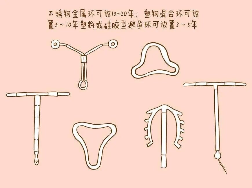 元宫型Cu365宫内节育器放置视频，从怕疼到放心的完整指南